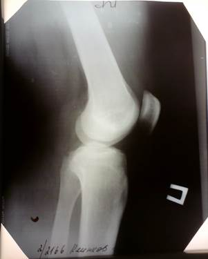 Рентгенограмма правого коленного сустава в двух проекциях 1