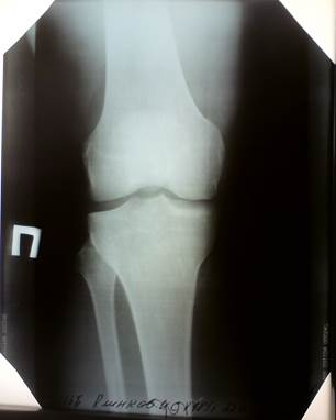 Рентгенограмма правого коленного сустава в двух проекциях 2
