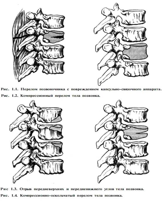 Диагностика травм позвоночника и спинного мозга 1