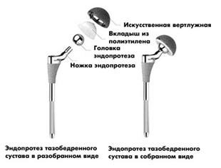 Анатомия бедренной кости 13